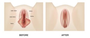 before and after labioplasty treatment Illustration