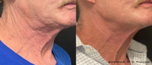before and after of neck Microneedling treatment