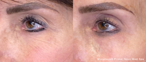 before and after Microneedling treatment for Cleveland