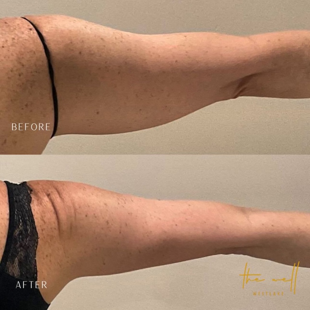 A patient enjoys slimmer arms after BodyTite, similar to a FaceTite procedure, in Westlake.