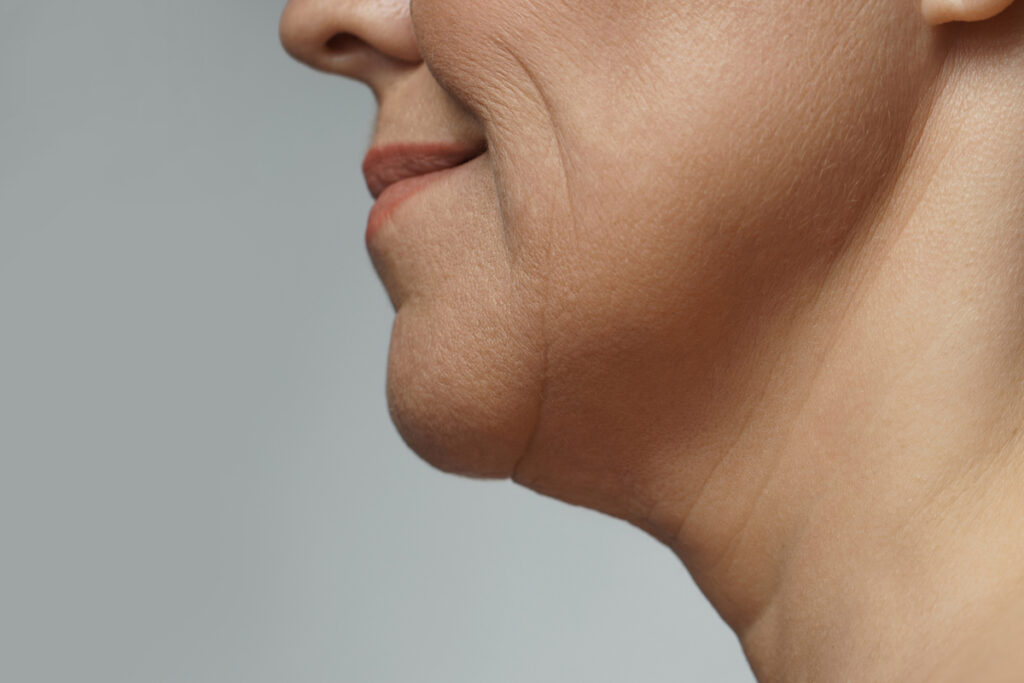 A close up of a woman's lips and chin are being used to show the results of skin tightening in Westlake, OH.