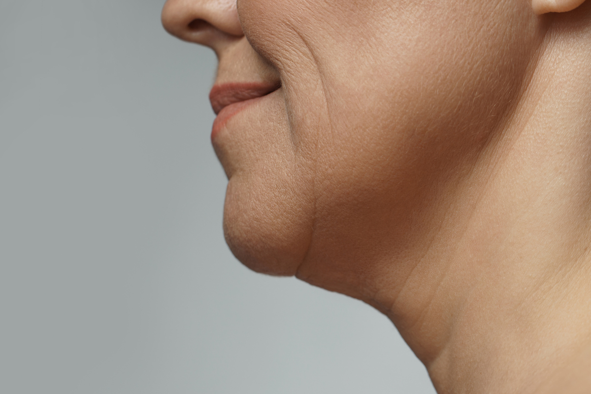 A patient experiences skin laxity and sagging fat deposits prior to a FaceTite procedure in Westlake.
