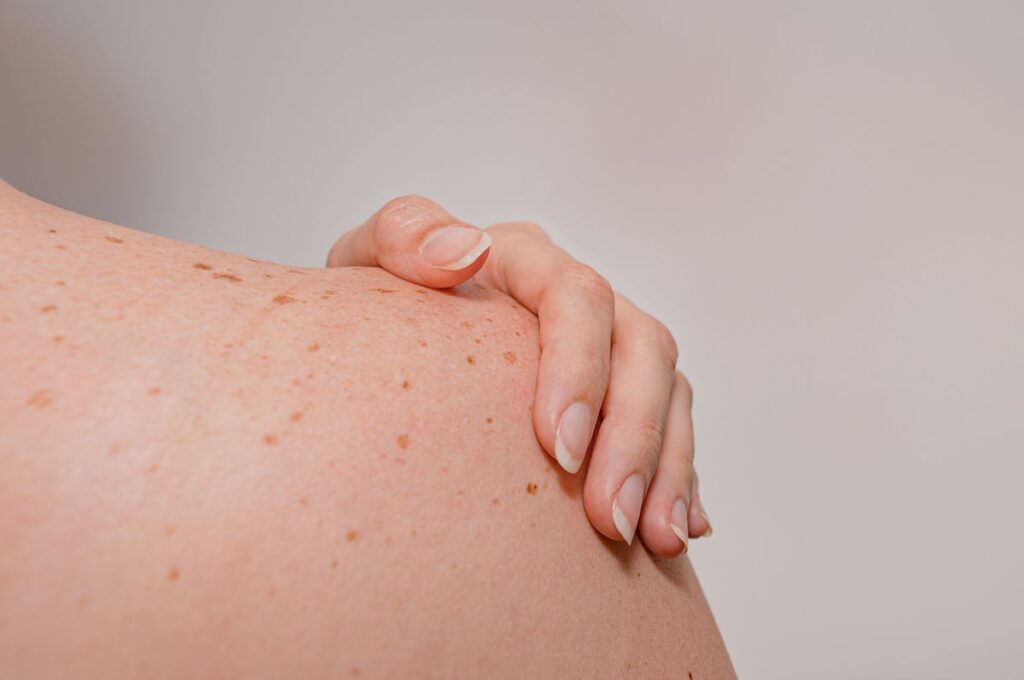 A woman is brushing her hand over her shoulder which is covered in sunspots and can be treated with Morpheus8 in Westlake, OH