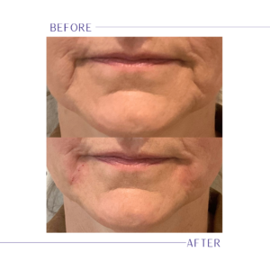 A before and after showing a patient's Marionette lines after receiving dermal filler in Westlake, OH.