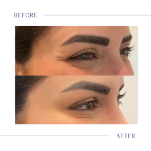 A before and after showing a patients eyes after receiving botox and dermal filler in Westlake, OH.