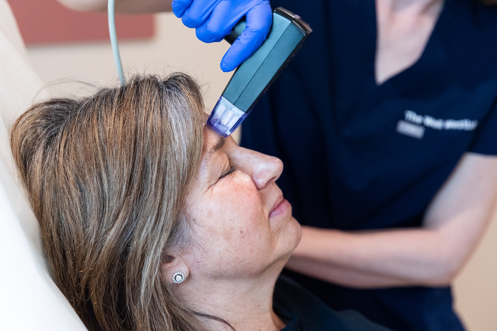 A close up of a patient receiving microneedling for their acne scar treatment in Westlake, OH