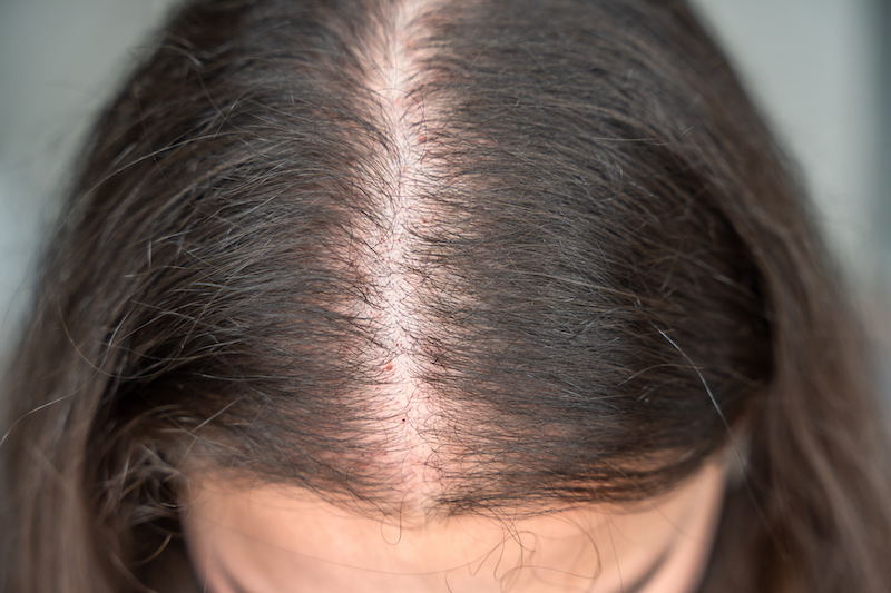 A picture of a woman's scalp before she undergoes a hair loss treatment in Westlake, OH.