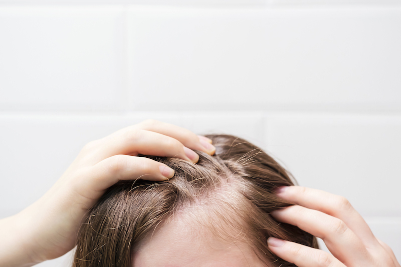 A before picture of a woman's thinning scalp before joining our program for hair restoration in Cleveland.