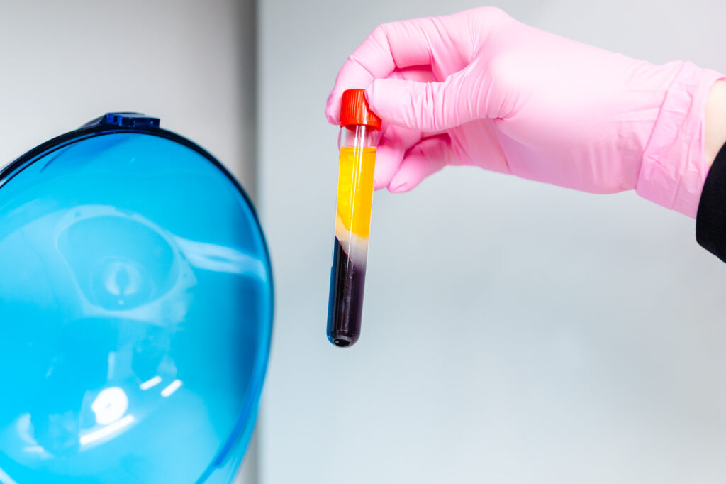 A gloved hand moving the vial for PRP Injections in Westlake toward a centrifuge.