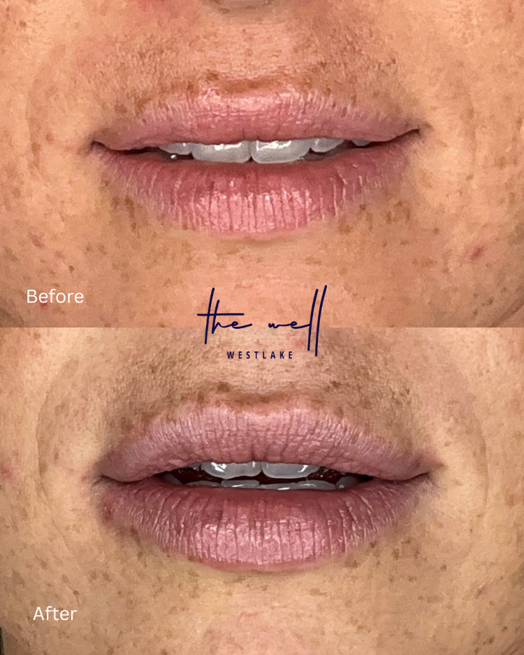 A patient's before-and-after photos reveal more plush, symmetrical lips after her lip fillers in Westlake.