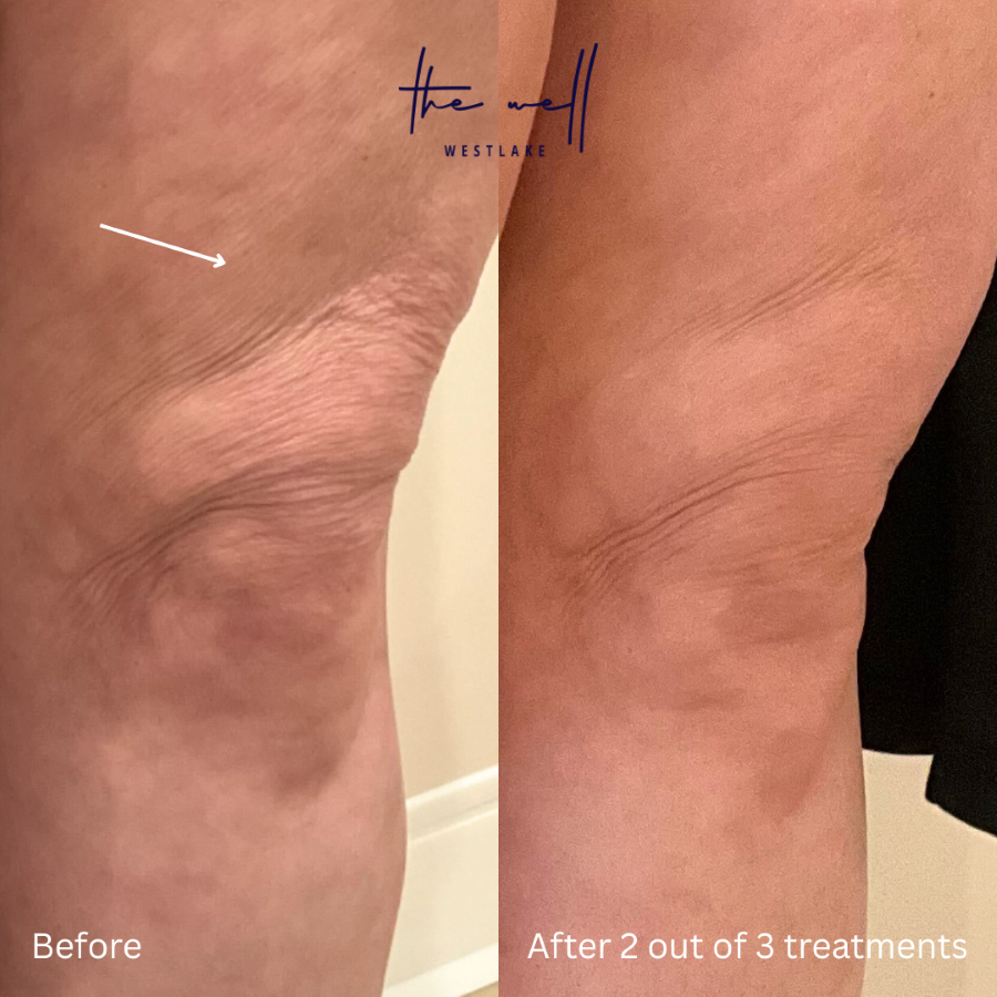  A patient's before-and-after photos show her results after RF microneedling in Westlake.