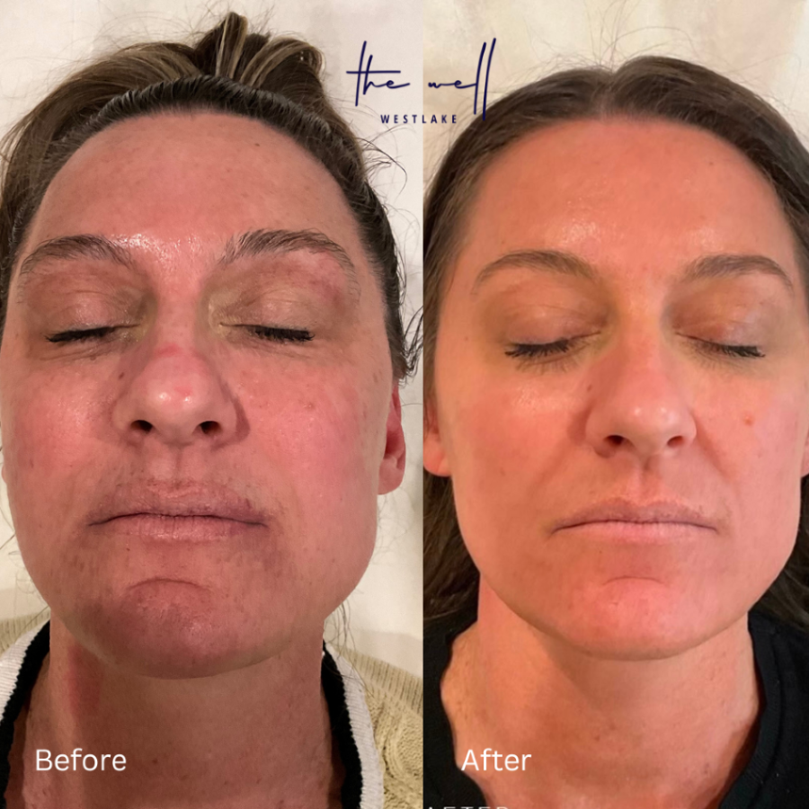 Before-and-after photos reveal a patient's even complexion after treatment with a facial laser near Cleveland.